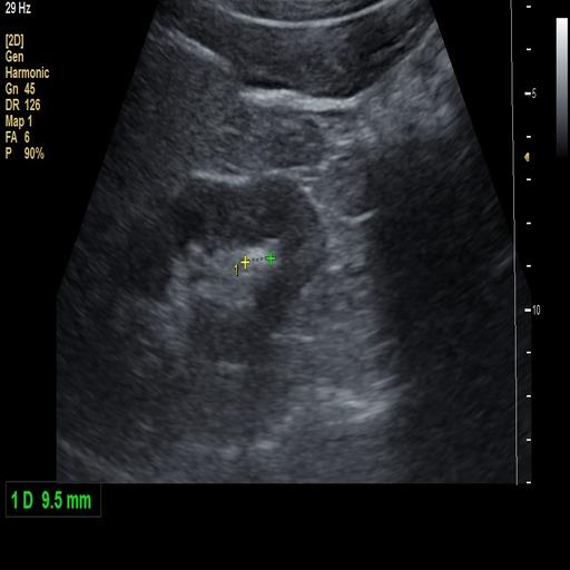 Kidney stone detection ultrasound preview